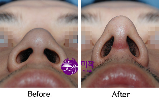 코성형중에서 필러 다음으로 인기가 많은 수술.JPG | 인스티즈