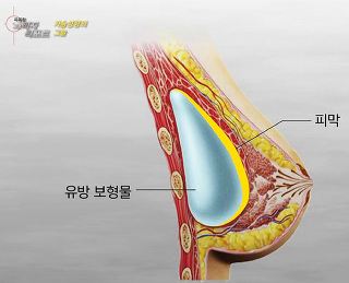 가슴성형의 그늘 | 인스티즈