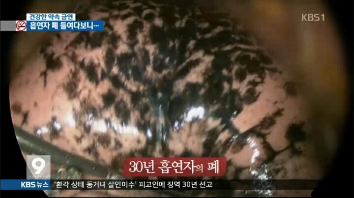혐오주의) 흡연자의 폐 | 인스티즈