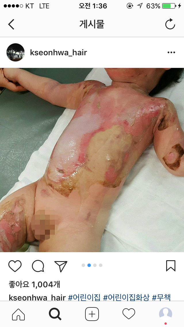 화상 입은 애기 나몰라라 하는 어린이집 | 인스티즈