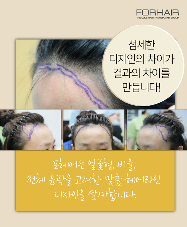 미미헤어라인 이미지
