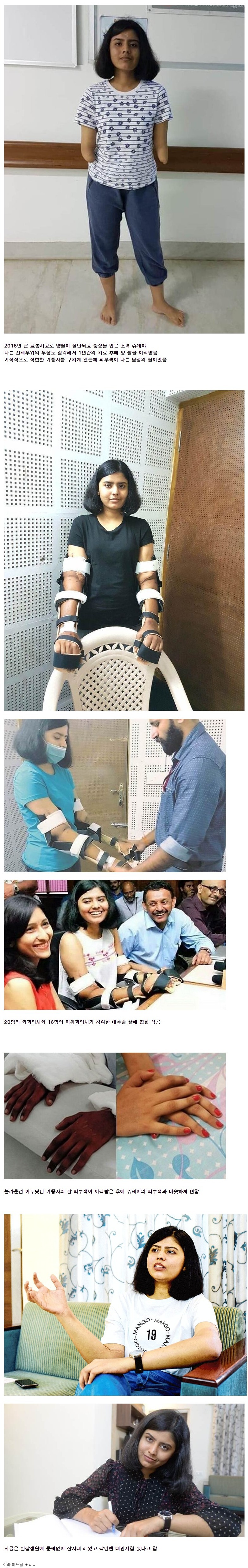 팔 절단 후 이식 받은 사람.jpg | 인스티즈